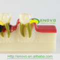 EN-M8 Dental Disease Developing Model/Dental Disease Model